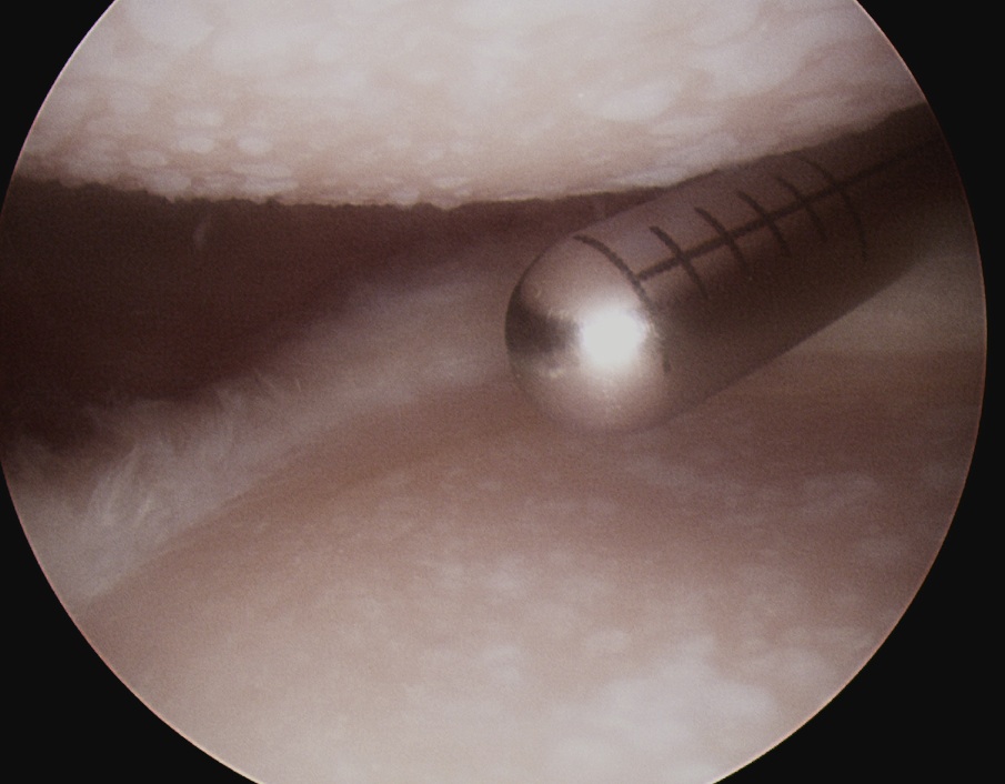 Shoulder OA Debridement